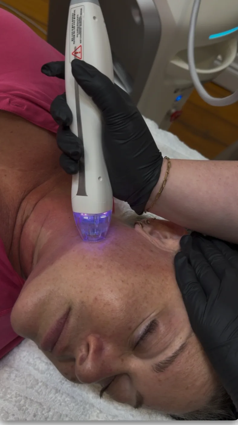 The Virtue RF handpiece delivering a controlled, insulated-needle treatment to the décolletage