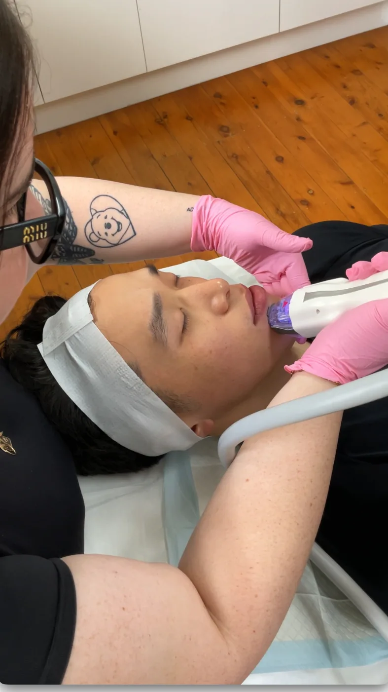 A Virtue RF microneedling treatment in progress at Brisbane Skin & Aesthetics